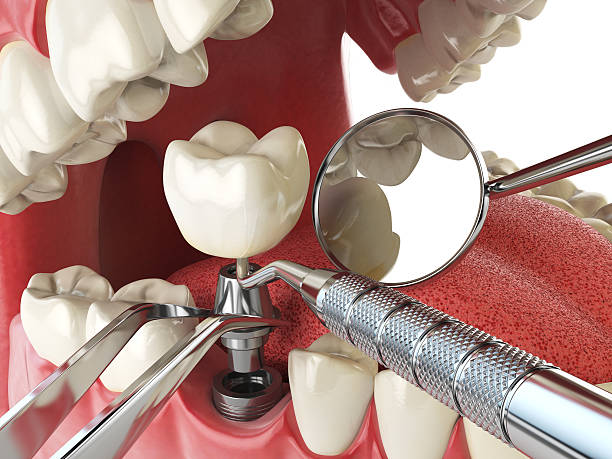 Best Emergency Denture Repair in Woodlawn Beach, FL